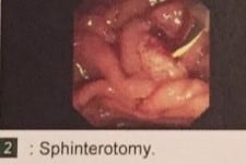 Sphinterotomy Image